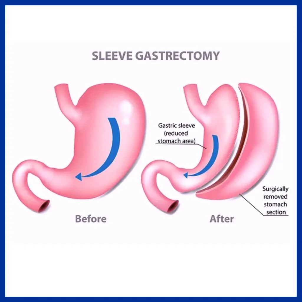 1. Sleeve Gastrectomy in Guwahati image 3