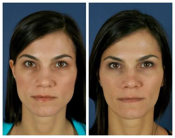 2. Treatment for Teeth Grinding (Bruxism) image 3