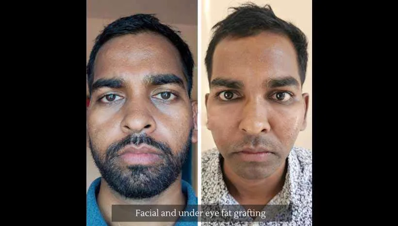 2. Under Eye Fat Transfer image 2