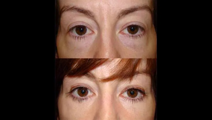 2. Under Eye Fat Transfer image 3