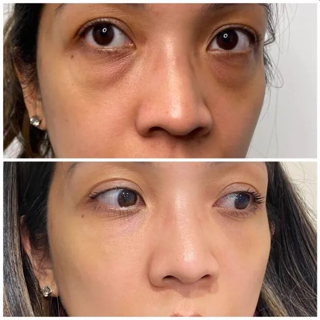 4. Under Eye Fillers (Tear Trough Correction)