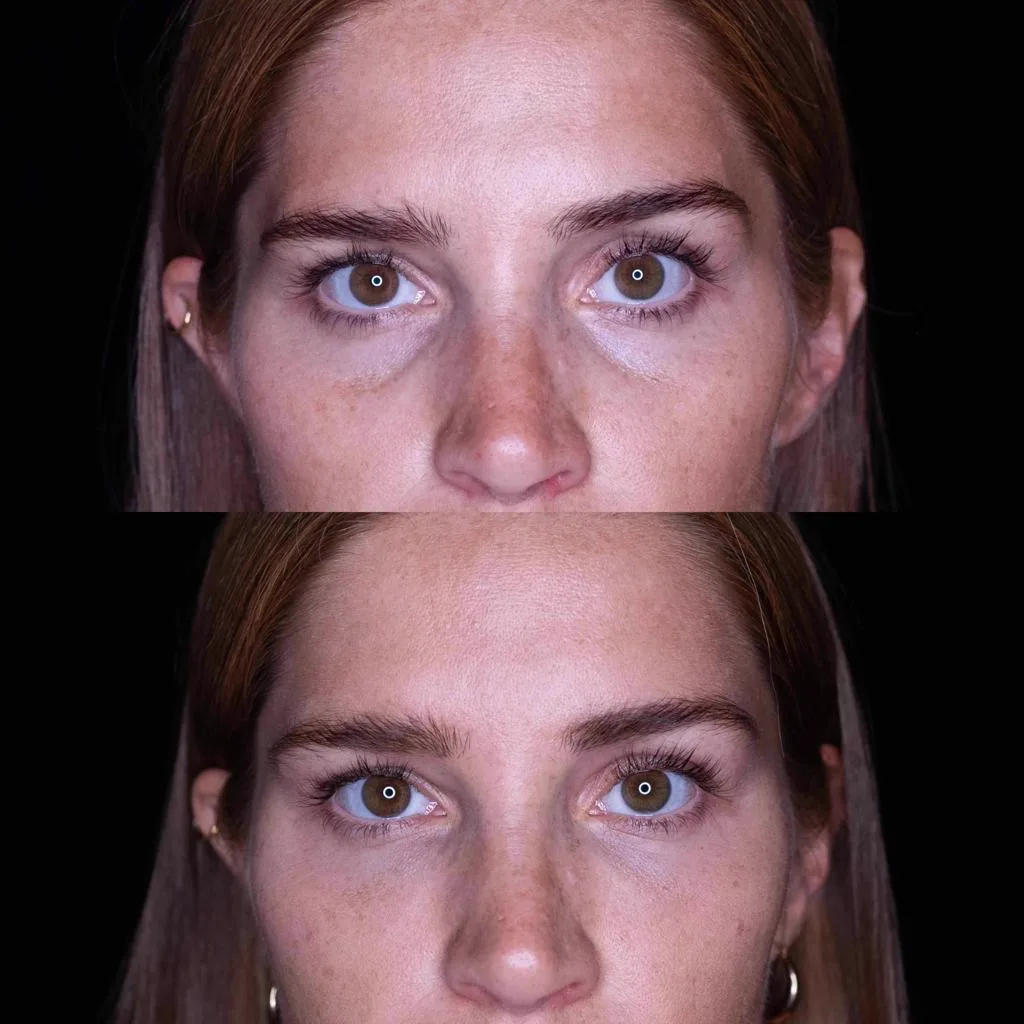 4. Under Eye Rejuvenation (Dark Circles & Fine Lines) image 1