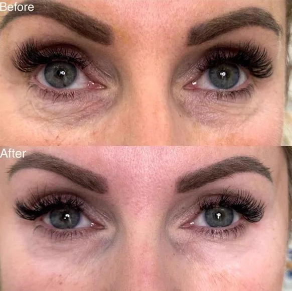 4. Under Eye Rejuvenation (Dark Circles & Fine Lines) image 3