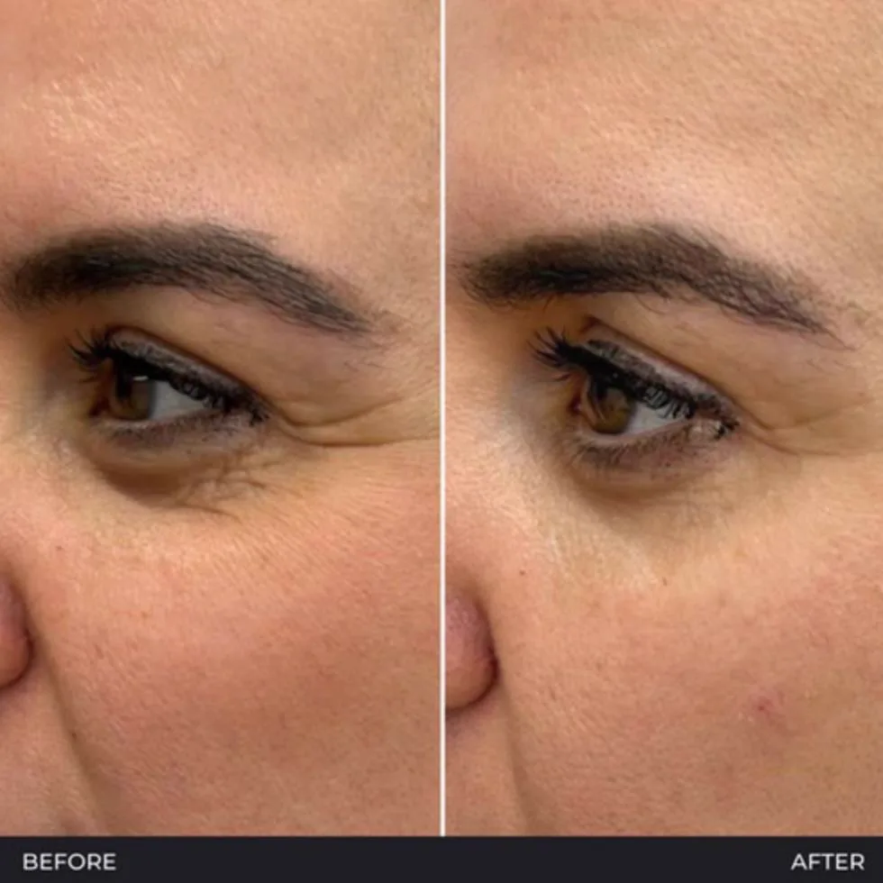 4. Under Eye Skin Boosters image 3