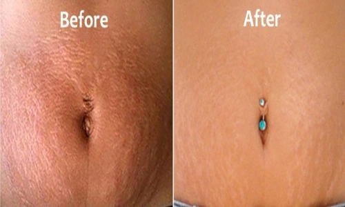 Stretch Marks & Scars Removal